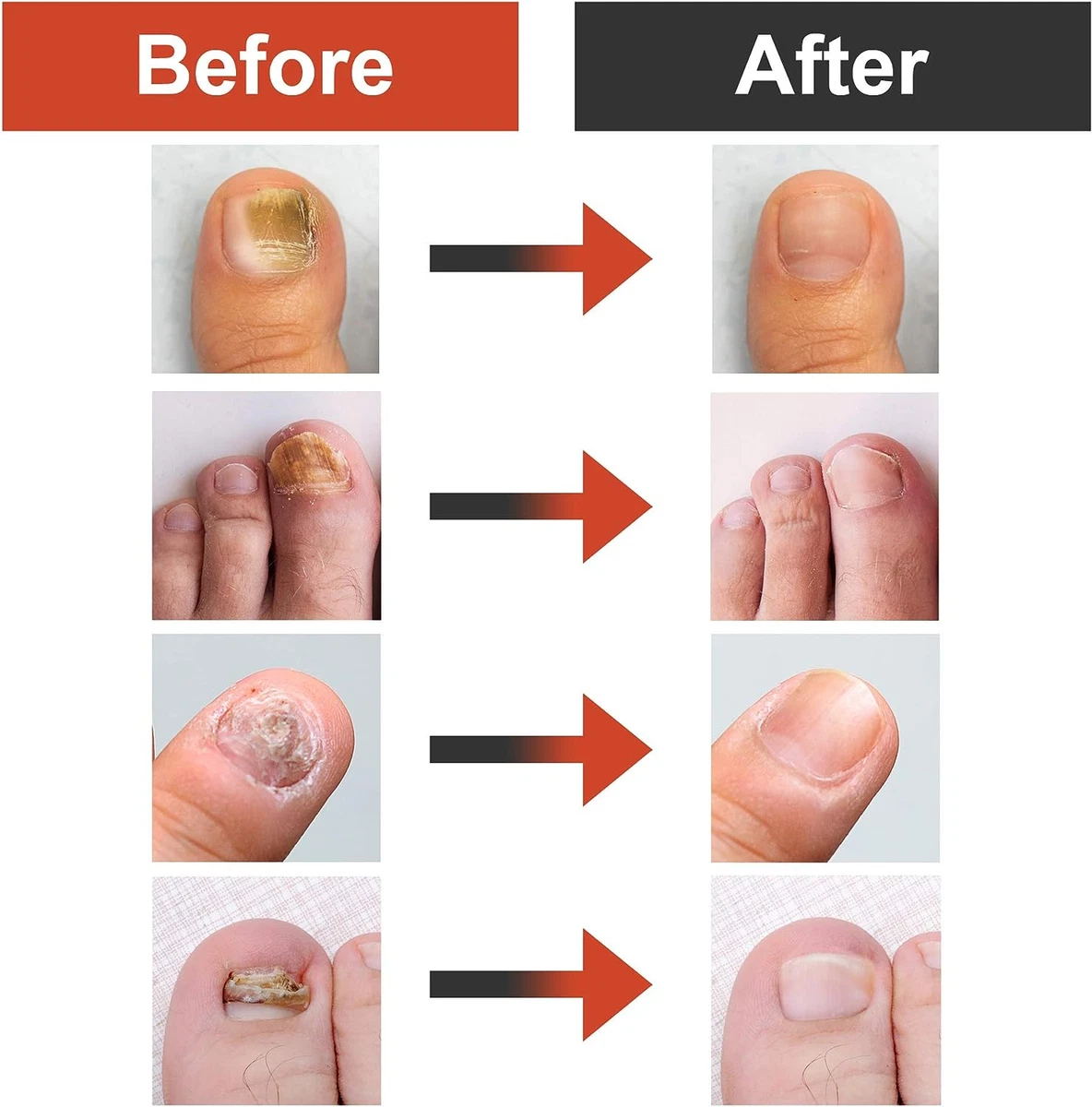 Update more than 140 severe fungal nail treatment ceg.edu.vn