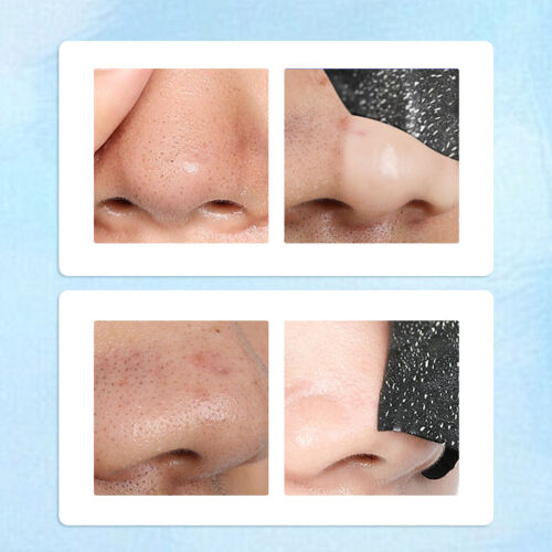 100PCS Nose Pore Strips Blackhead Removal Unclog Pores Deep Cleansing Head - Picture 9 of 12
