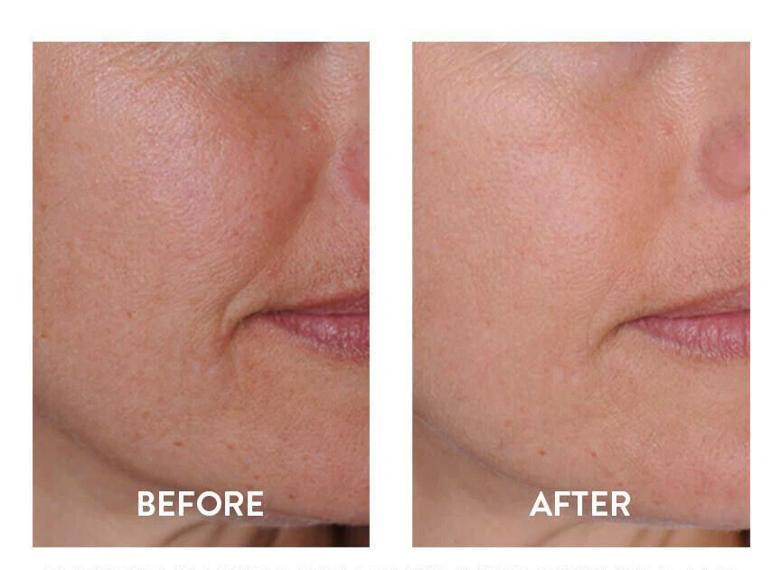 HYALURONIC ACID 100% Pure Anti Aging Hydrating Serum, Plumps Wrinkles Fine Lines - Image 2 of 4