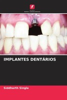 Siddharth Singla | Implantes DentÁRios | Taschenbuch | Portugiesisch (2022)