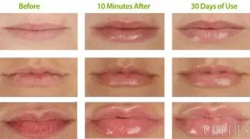 (Lot of 2).Sally Hansen Lip Inflation Plumping Treatment - 6690-15 Clear gloss - Image 3 of 3