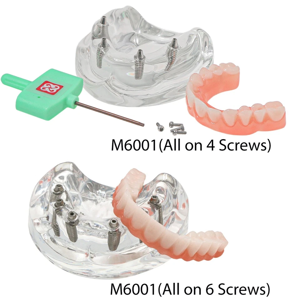 US All-on-4/6 Screws Restoration Overdenture Dental Implant Model Upper Jaw - Image 4 of 4