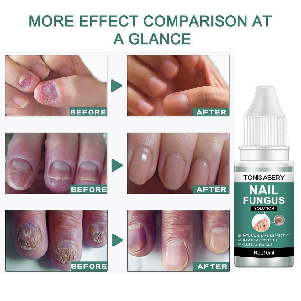 Fungal Nail Repair Essence Serum Care Treatment Foot Removal Fungus J9K