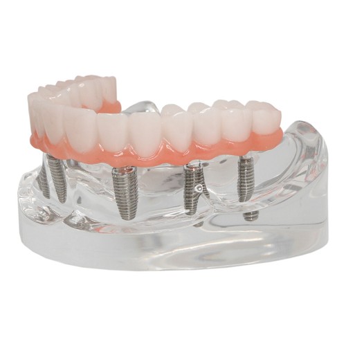 Dental Implant Restoration Model Upper Jaw 6 Screws Post Core Bridges M6001-2 - Picture 5 of 9