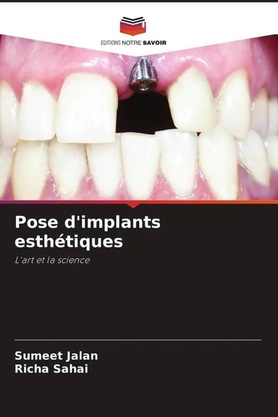 Pose D'implants EsthéTiques L'art Et La Science Sumeet Jalan (U. A.) Taschenbuch-image