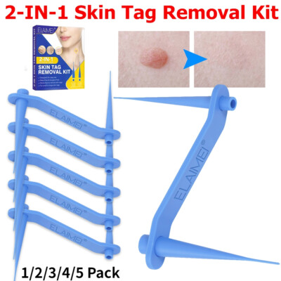 Auto Micro Skin Tag Remover Device Kit Safe Painless Removal 2-7 mm Band Tool