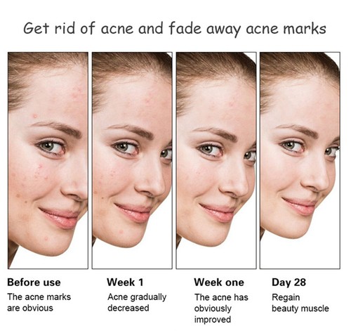 AICHUN BEAUTY Anti-Acné Blanqueador Suero Facial Extracto de Aloe Vera Ácido Salicílico - Imagen 8 de 10