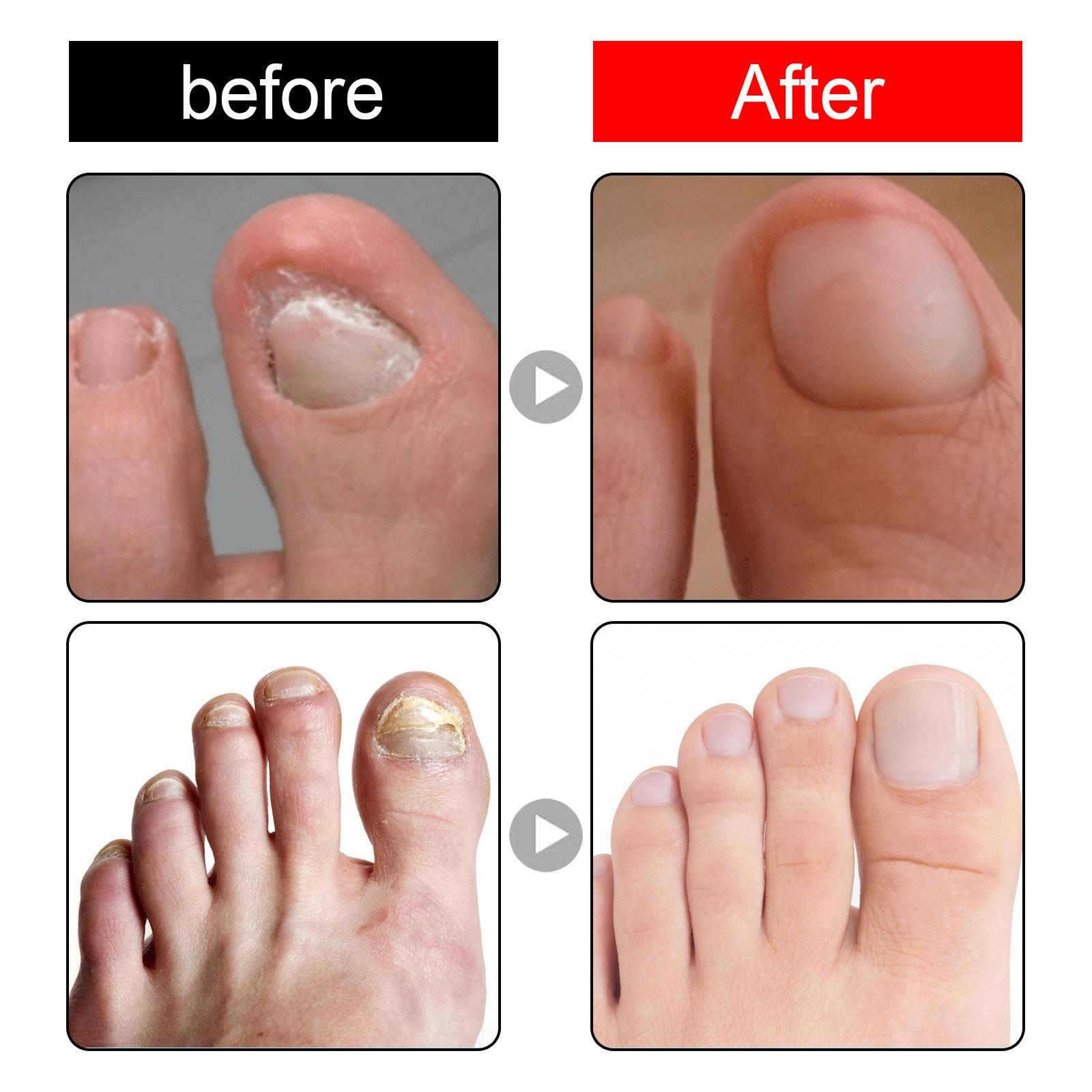 Ingrown Toenail Treatment Serum Nail Correction Pains Reliever Recovers