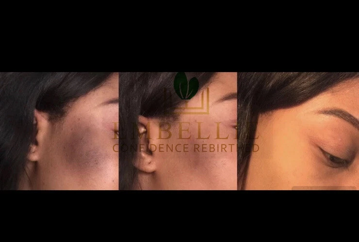 Aceite sérico removedor de quemaduras solares, suero Dark Mark Fade Foto 4 de 4