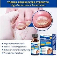 Mejor Tratamiento Para Los Hongos En Las Uñas De Los Pies Dedos Cura Hongos