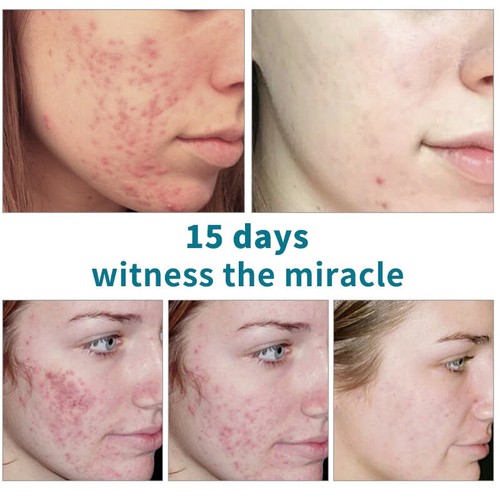 Natural Aloe Acne Removal Gel Serum Moisturizing Oil Control Soothing Face Care - Picture 2 of 6