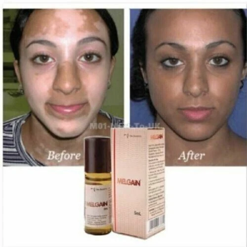 Melgain Lotion for Vitiligo White Spots Patches 5ml