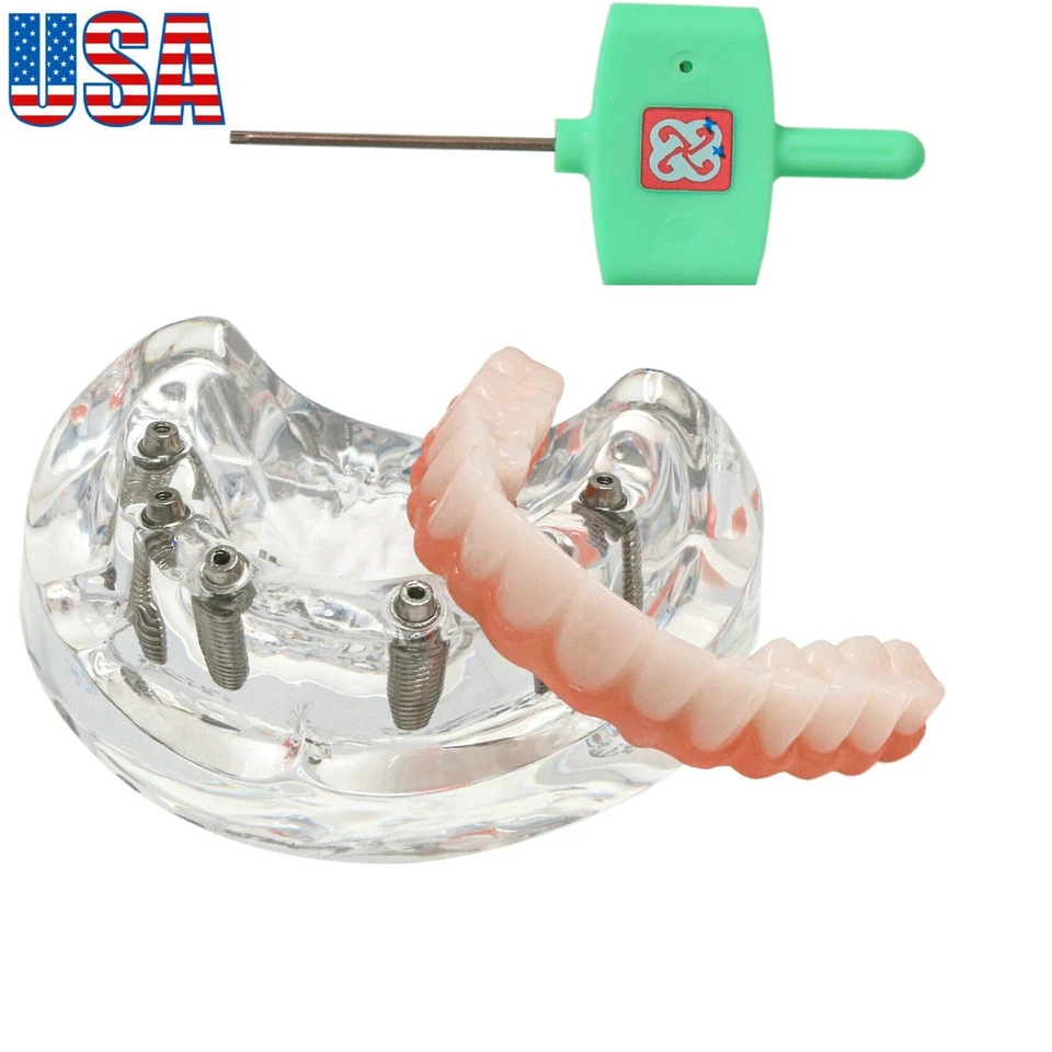 US All-on-4/6 Screws Restoration Overdenture Dental Implant Model Upper Jaw - Image 3 of 4