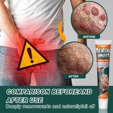 Top Genital Warts Remover Cream for Skin Tags Body Discomfort Relief