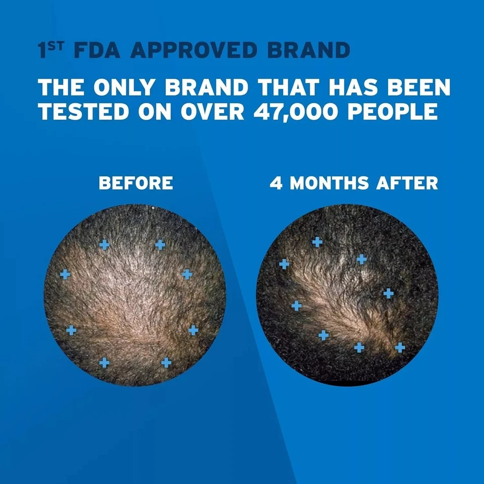 Rogaine Recrecimiento del Cabello para Hombres ESPUMA ES 2 OZ Botellas (La Caja tiene 3 Botes) Foto 4 de 4