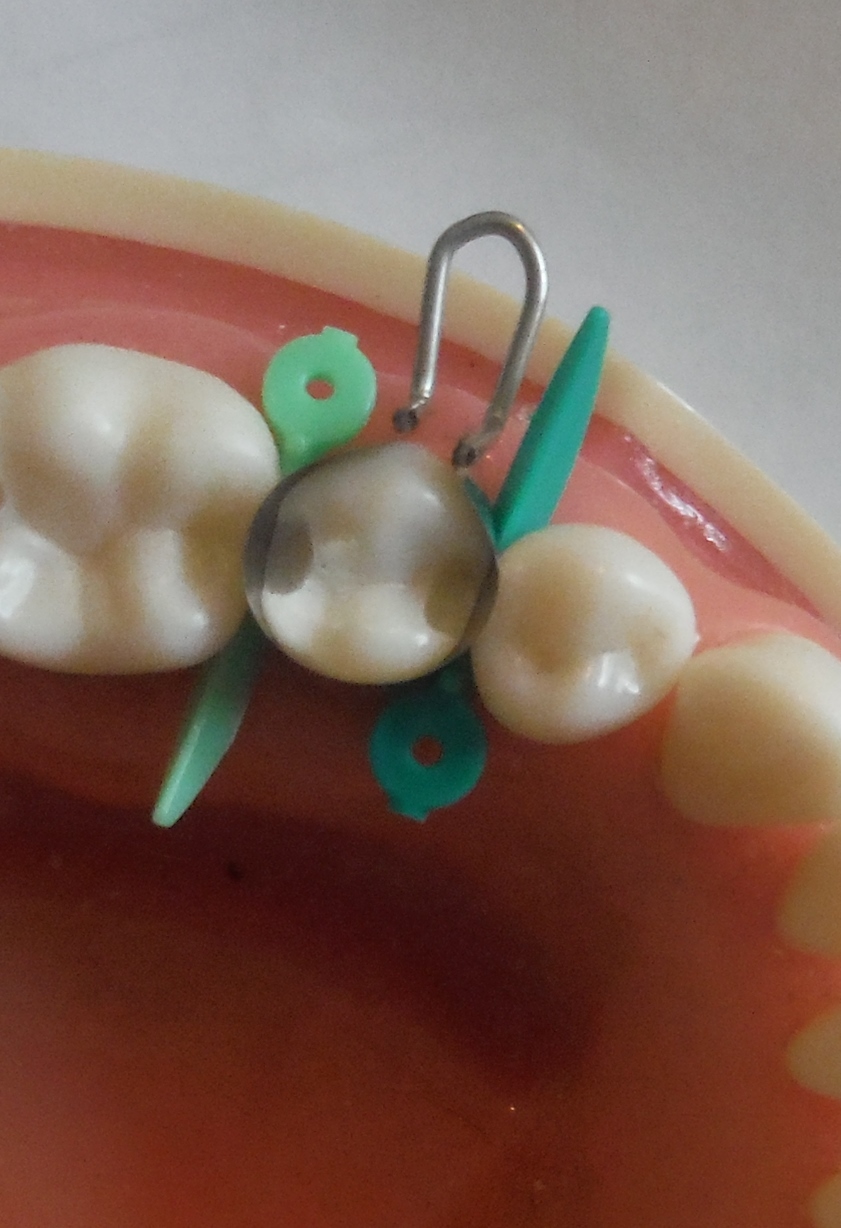 Dental Matrix Bands/ The U Dental Bands.Premolars. eBay