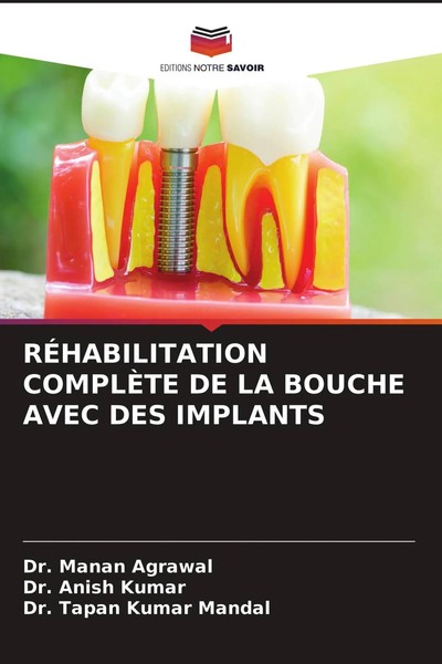 Manan Agrawal (U. A.) | RÉHabilitation ComplÈTe DE LA Bouche Avec DES Implants-image