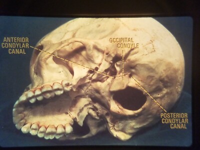 XAN11 35mm Slide Photo Vintage FORAMINA OF THE SKULL OCCIPITAL CONDYLE....