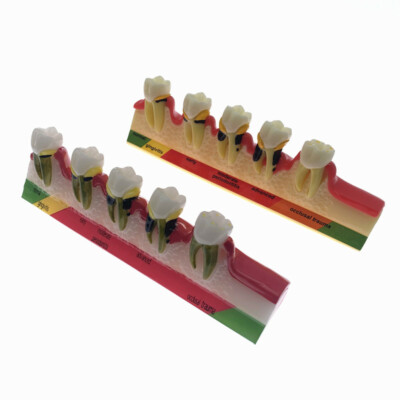 Dentist Odontologia Periodontal Disease Dental Teeth Model Tooth dental Model