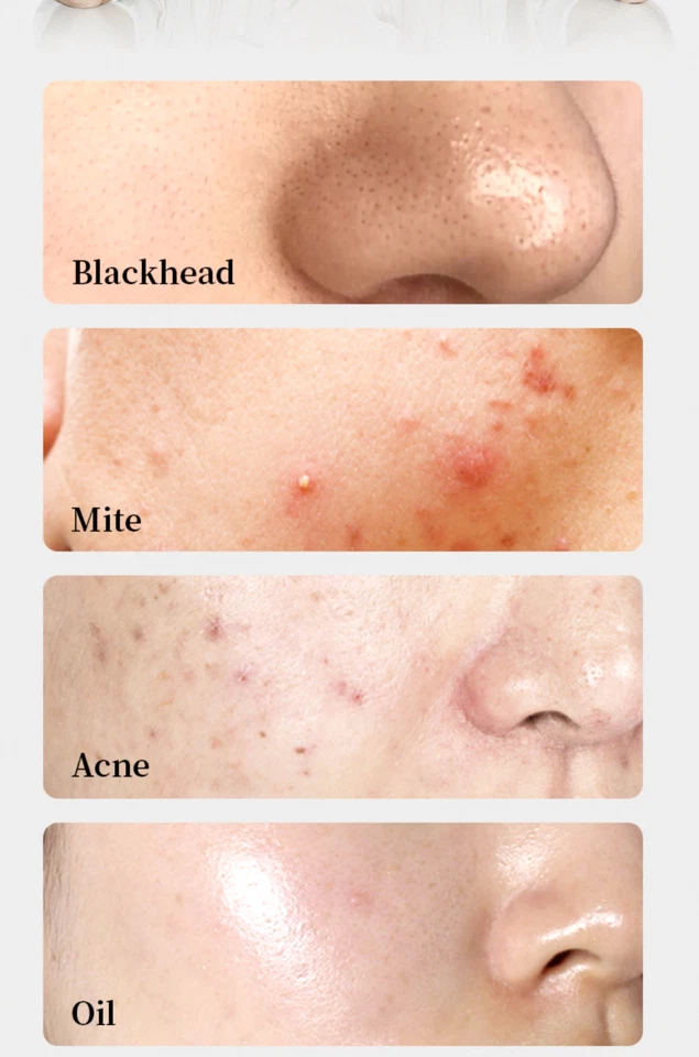 Removedor visual de espinillas, limpiador facial y de piel aspiradora de acné de poros conexión WiFi APP Foto 4 de 4