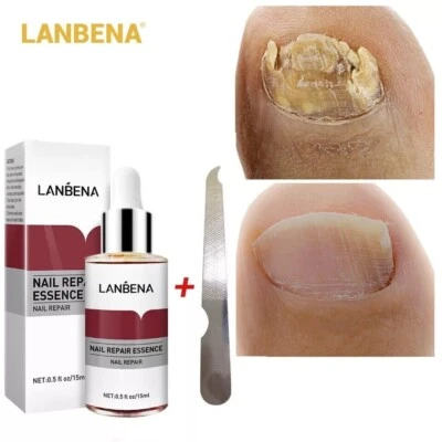 LANBENA Nail Repair Remove Onychomycosis Serum Fungal Treatment UK