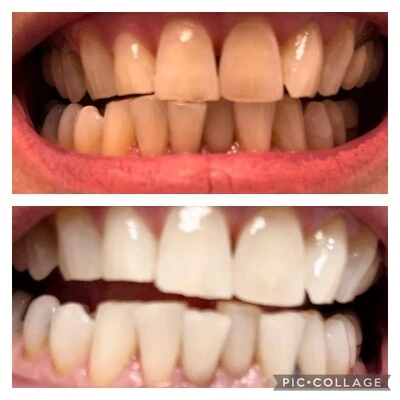 Very Strong Teeth Whitening Refill Gel No:36 Professional Grade, Strong9ml