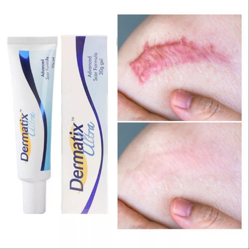 Dermatix gel outlet