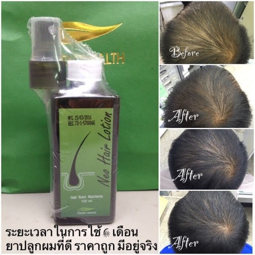 Buy 2x Green Wealth Neo Hair Lotion Hair Loss Growth Root Nutrients