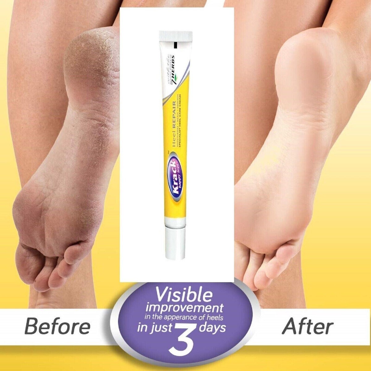 Nu Skin Sole Solution - Crème Spéciale Pour Talons - Pack De 3 Tubes Scellés - 25g Chacun - Hydratant Et Antifongique
