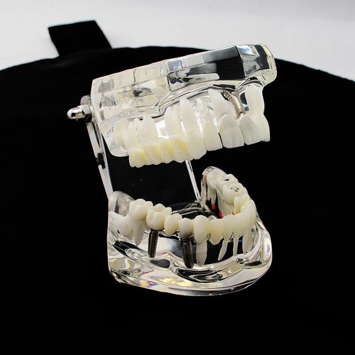 Estudio de enfermedades de implantes dentales modelo de enseñanza de dientes puente de restauración análisis dental - Imagen 4 de 12