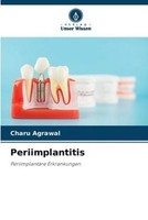 Periimplantitis Charu Agrawal