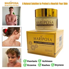 MARIPOSA Skin Treatment 85g For Scabbies Itchy Psoriasis Eczema Ringworm