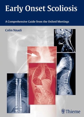 Early Onset Scoliosis | A Comprehensive Guide from the Oxford Meetings | Nnadi