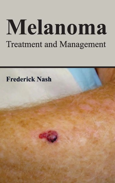 Frederick Nash | Melanoma | Buch | Englisch (2015) | Treatment And Management-image