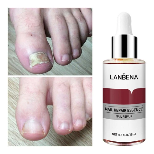 5x LANBENA Esencia Reparadora de Uñas Eliminar Onicomicosis Suero Tratamiento Fúngico de Uñas - Foto 9 de 16