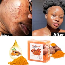 Tumeric Soap Skin Whitening Dark Spots lightening Acne Brightening Turmeric 100g