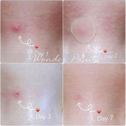 36pcs Acne Dots Pimple Patches Cystic Acne Patch Hydrocolloid Acne Spot Sticker - Picture 12 of 12