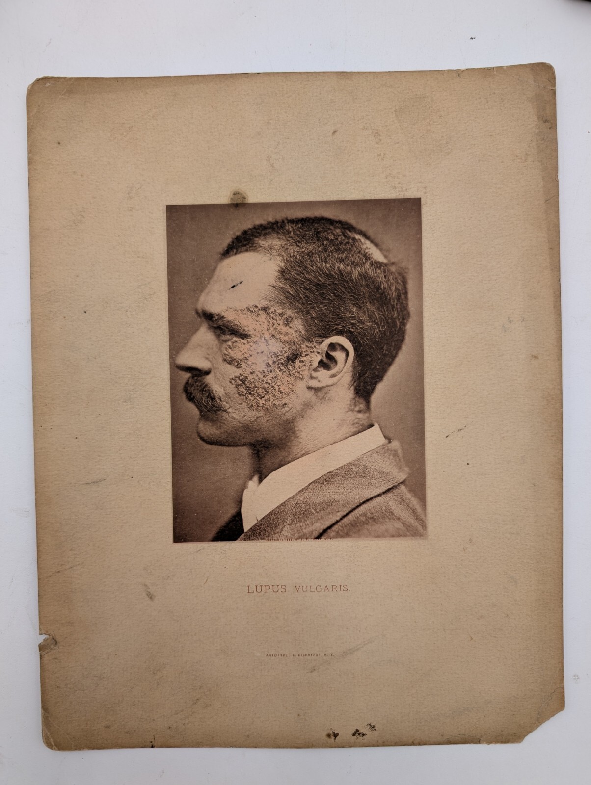 Antiguo artetipo fotos de la condición de la piel 1885 E.B tratar el lupus vulgar médico