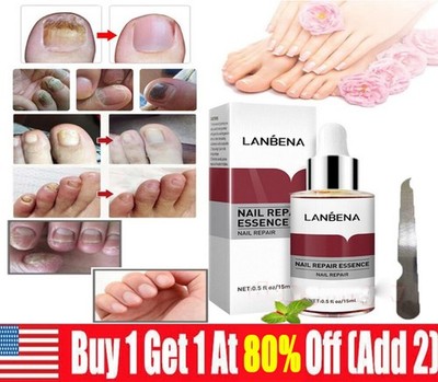 U29989 LANBENA Nail Repair Essence Remove Onychomycosis Serum Fungal Nai G1N