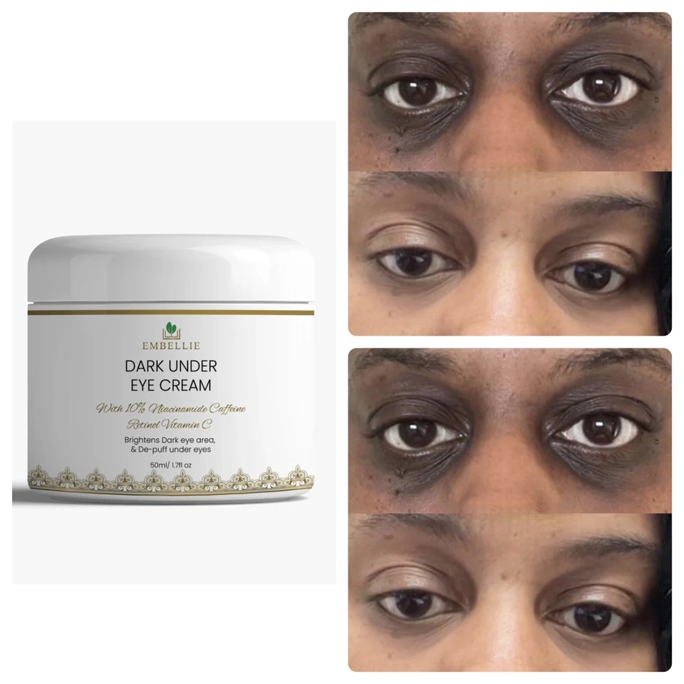 EMBELLIE SKINCARE Dark Under Eye Brightening Cream, Dark Circle Remover, Eye Cream, Retinol, 100ml