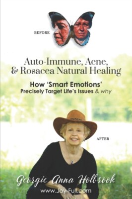 Holbrook - Auto-Immune Acne  Rosacea Natural Healing - How 'Smart E - X555z