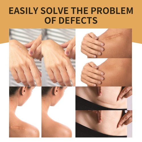 6patch/Box Invisible Concealer Skin Mask Concealer Tattoo Scar Mask Waterproof - Picture 4 of 5