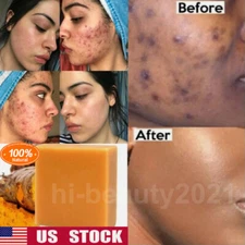 Tumeric Soap For Dark Spots, Skin Lightening, Anti Acne Skin Cleansing Soap Bar~