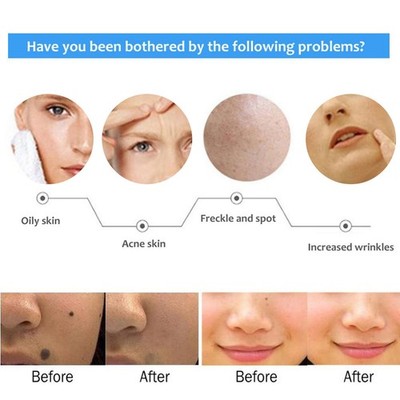 US Plug 110V Ultrasonic Freckle Spots Removal Machine Detoxifying Face Care BAK