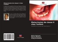 Malocclusion De Classe II Chez L'enfant Naina Agarwal