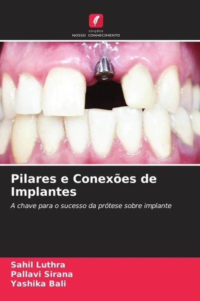 Pilares E ConexõEs De Implantes A Chave Para O Sucesso Da PróTese Sobre Implante-image