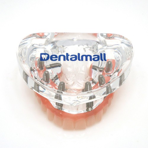 Dental Implant Restoration Model Upper Jaw 6 Screws Post Core Bridges M6001-2 - Picture 2 of 9