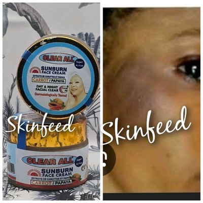X2. Clear All Sun Burn Day & Night Face Cream. 50g X 2 NOT FOR SENSITIVE skin. 