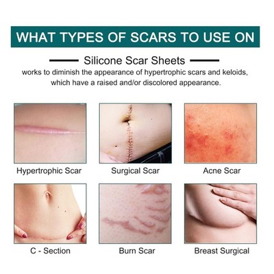 Reusable Silicone Scar Strips - C-Section, Surgery, Acne