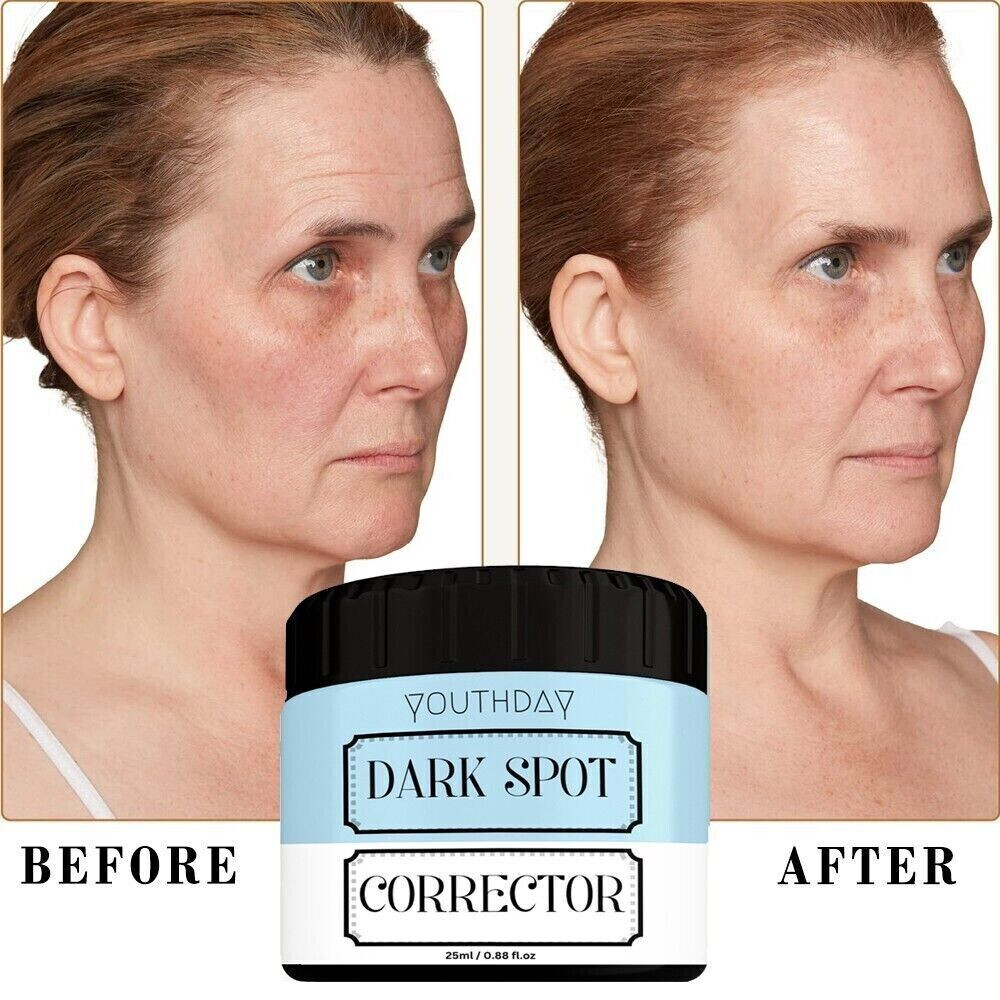 Dark Spot Remover for Face, Body, Age Spots, Sunspot, Dark Spots